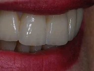 Riabilitazione dentale protesi su impianti totale fissa non mobile a pavia belgioioso