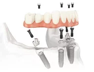 Riabilitazione dentale protesi su impianti totale fissa non mobile a pavia belgioioso